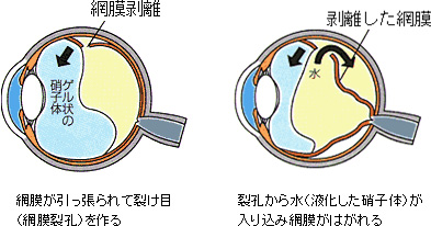 網膜剥離とは