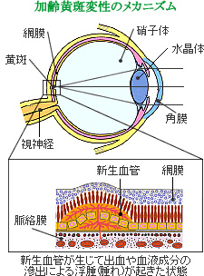 加齢黄斑変性とは 加齢黄斑変性とは